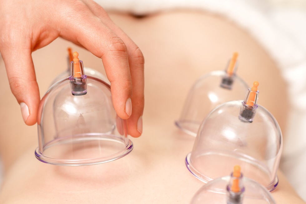 Cupping and Dry Needling at AJ Physical Therapy, Ooltewah