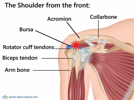 Shoulder Pain